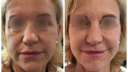 vampire facelift before and after 