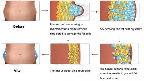 before and after of fat freezing fat cells