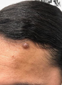 cosmetic mole removal 