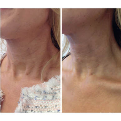 teosyal redensity neck before and after