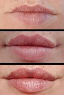before and after lip augmentation