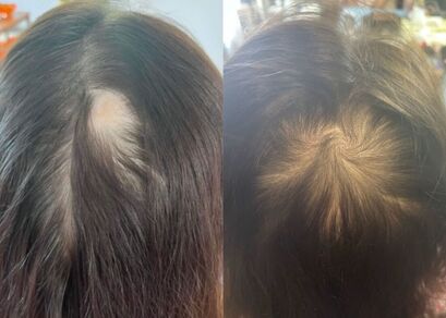 Vampire Hair Growth - Hair Loss Treatment - Face Doctors New Zealand - Face  Doctors