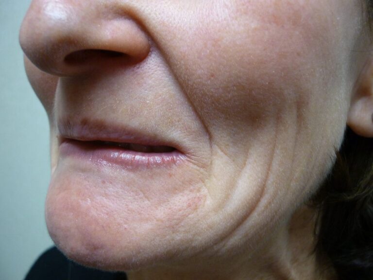 before-fillers-side-orig_orig