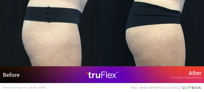 trusculpt-flex-b-a-zanetti-b2