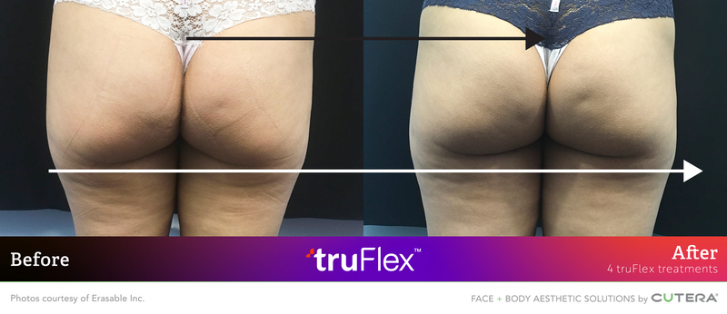 trusculpt-flex-erasable-inc-set