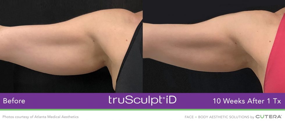 trusculpt-id-atlanta-medical-aesthetics-980x425_orig