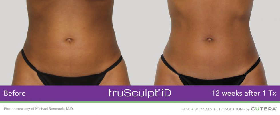 trusculpt-id-somenek-3-980x402_orig