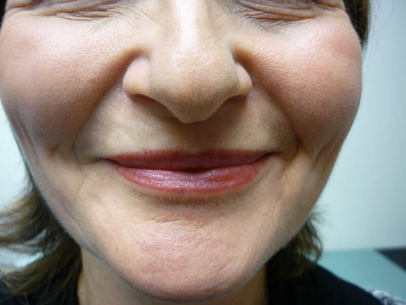 After cosmetic treatment