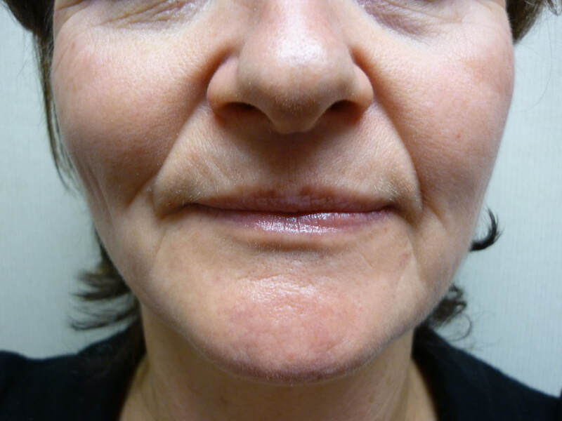Before cosmetic treatment