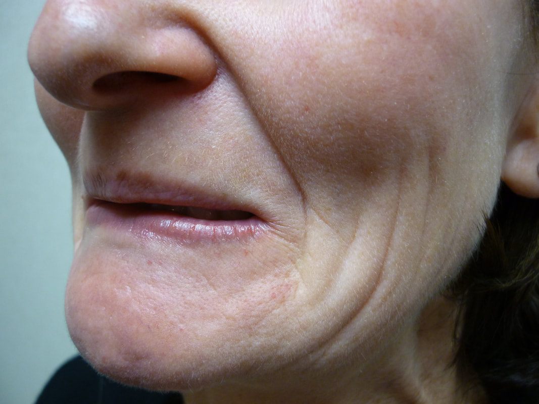 Before dermal filler treatment