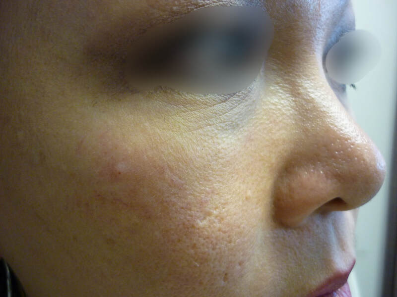 Dermal filler result
