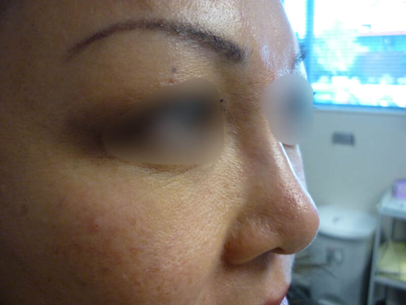 Dermal filler result
