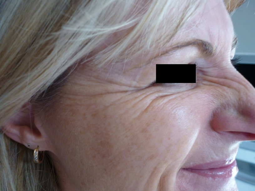 Before cosmetic treatment