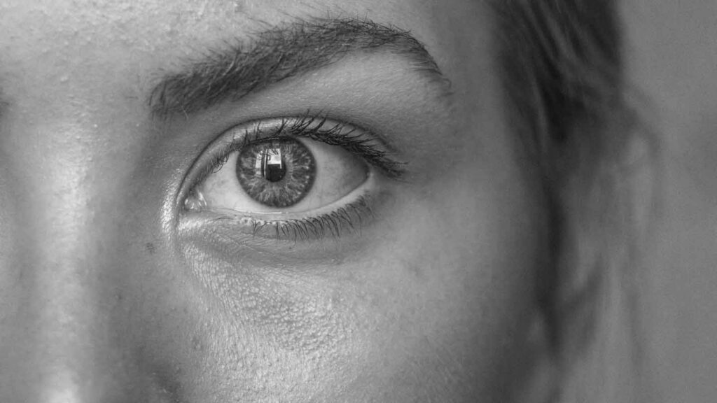 Close-up of eye and under-eye area showing natural skin texture and tear trough hollowing